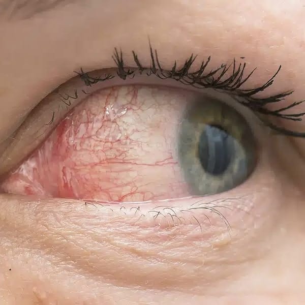 Dry Eye Syndrome Treatment