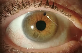 Glaucoma Treatment in Bareilly